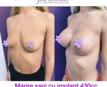 galerie-marire-sani-cu-implant-mamar-v3-02-430x430x0x26x430x378x1636448939