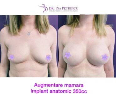 galerie-marire-sani-cu-implant-mamar-v3-06-430x430x0x39x430x353x1636448939